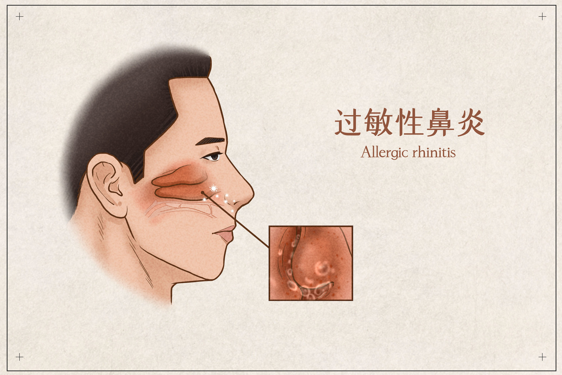 深圳孩子有过敏性鼻炎可以接种新冠疫苗吗