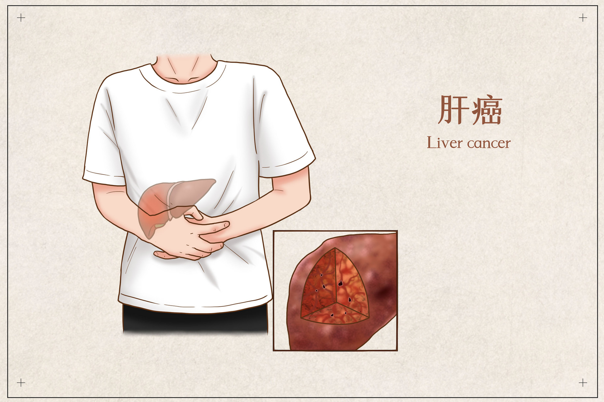 深圳哪里有免费的肝癌筛查（条件+入口）